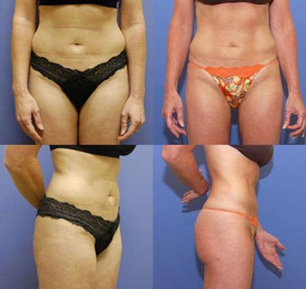 Liposuction: Case 1