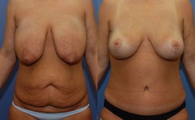 Tummy Tuck: Case 1