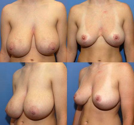 Breast Reduction: Case 1