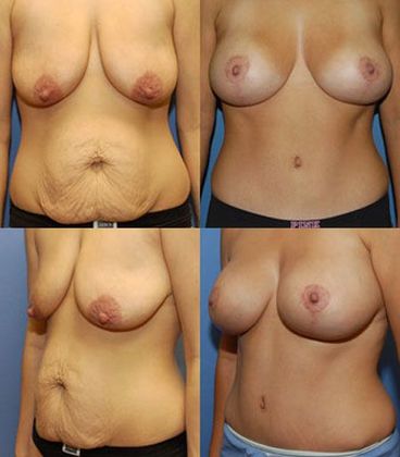 Tummy Tuck: Case 10