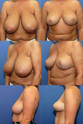 Breast Reduction: Case 10