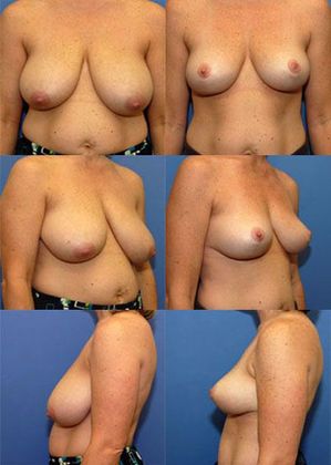 Breast Lift: Case 10: Oklahoma City