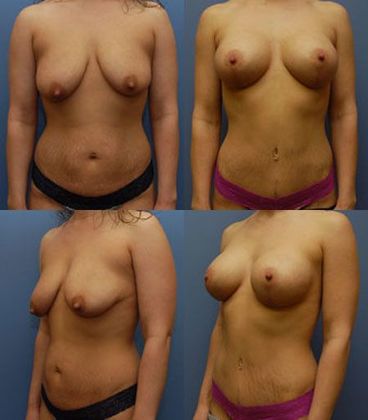 Tummy Tuck: Case 11