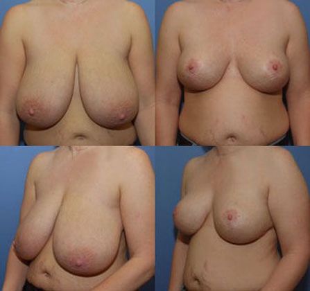 Breast Reduction: Case 11