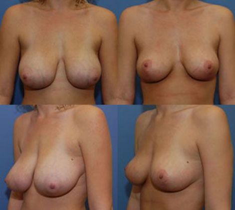 Breast Lift: Case 11