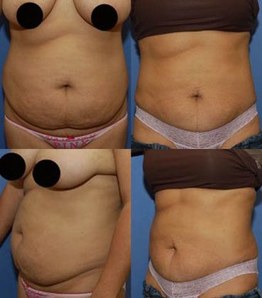 Tummy Tuck: Case 12