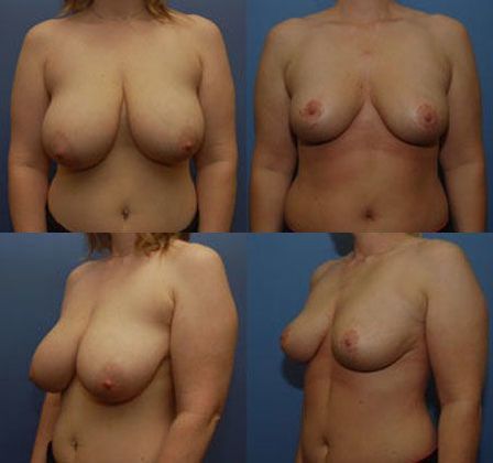 Breast Reduction: Case 12