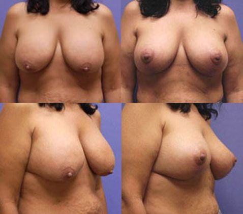 Breast Lift: Case 12
