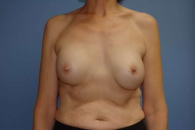 Case 125