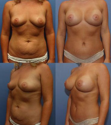 Tummy Tuck: Case 13