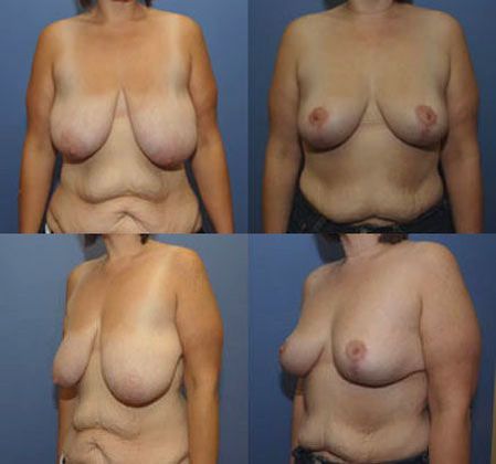 Breast Reduction: Case 13