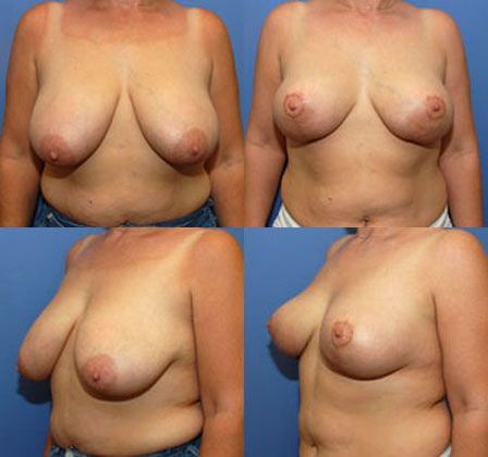 Breast Lift: Case 13