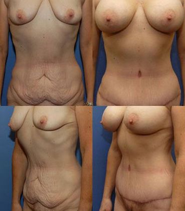 Tummy Tuck: Case 14