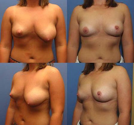 Breast Reduction: Case 14