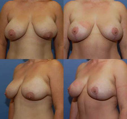 Breast Lift: Case 14