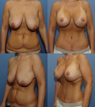 Tummy Tuck: Case 15