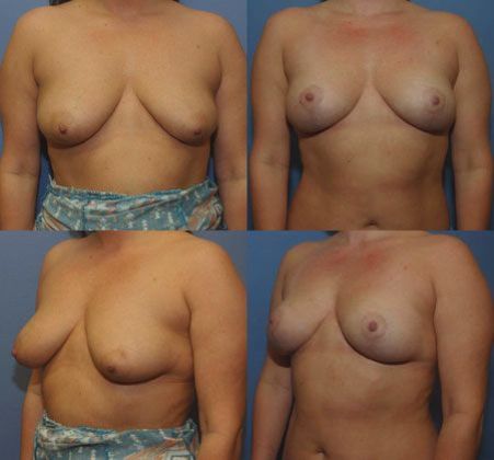 Breast Reduction: Case 15