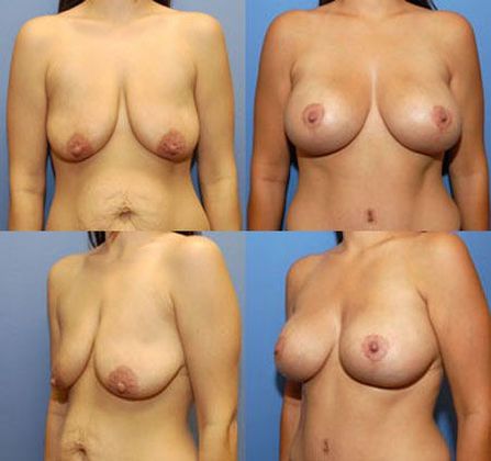 Breast Lift: Case 15