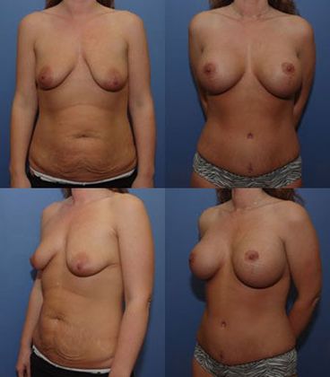 Tummy Tuck: Case 16