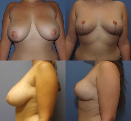 Breast Reduction: Case 16
