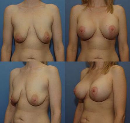 Breast Lift: Case 16