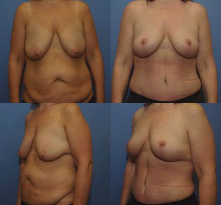 Tummy Tuck: Case 17