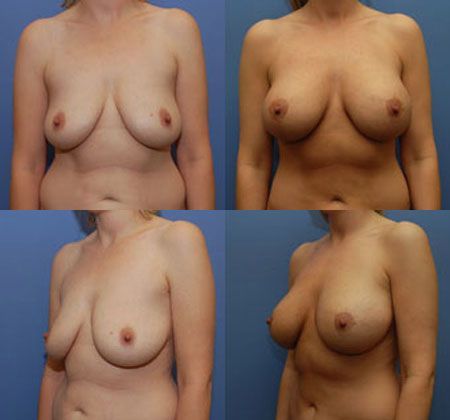 Breast Lift: Case 17