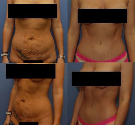 Tummy Tuck: Case 18