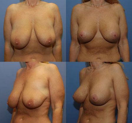 Breast Lift: Case 18