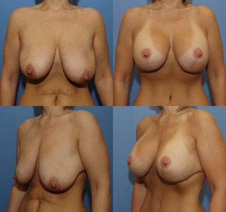 Breast Lift: Case 19