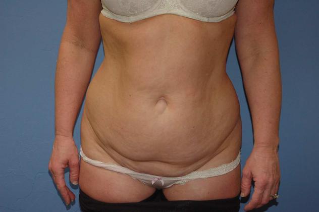 Tummy Tuck: Case 19