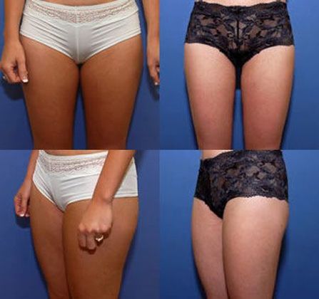 Liposuction: Case 2