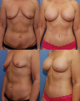 Tummy Tuck: Case 2