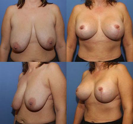 Breast Lift: Case 20