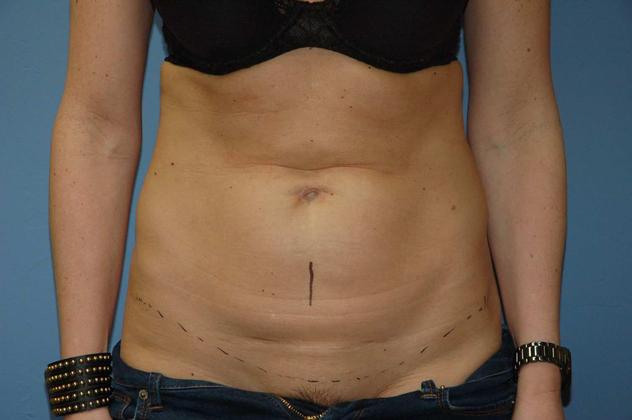 Tummy Tuck: Case 20