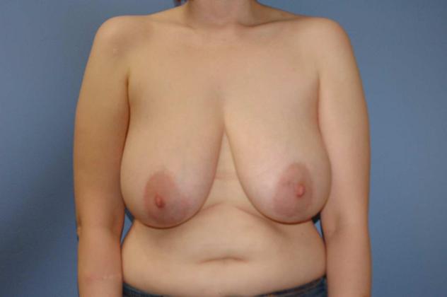 Breast Reduction: Case 20