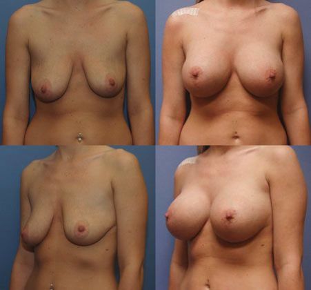 Breast Lift: Case 27