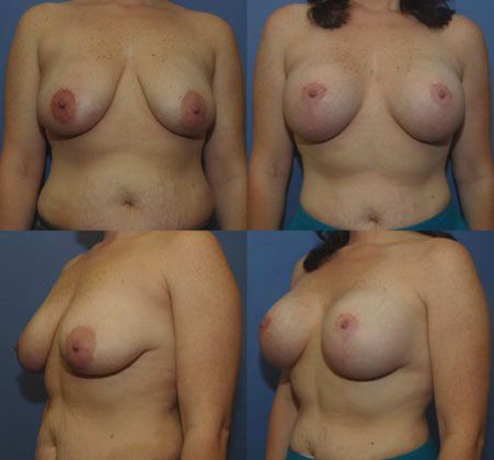 Breast Lift: Case 28