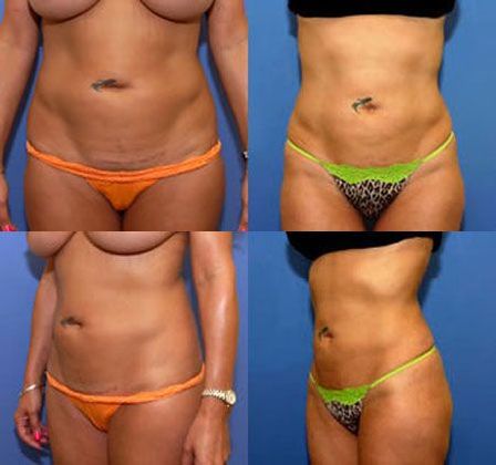Liposuction: Case 3