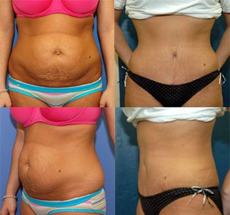 Tummy Tuck: Case 3