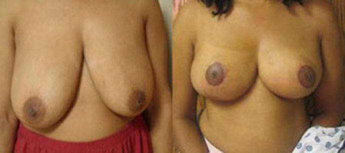 Breast Reduction: Case 3