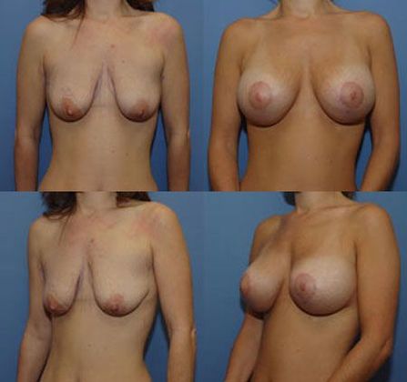 Breast Lift: Case 3: Oklahoma City