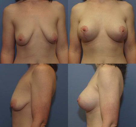 Breast Lift: Case 30