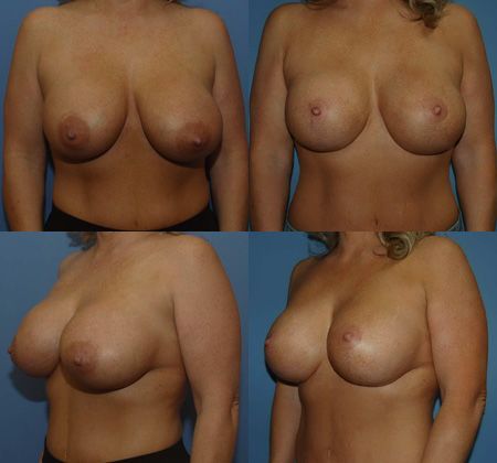 Breast Lift: Case 31