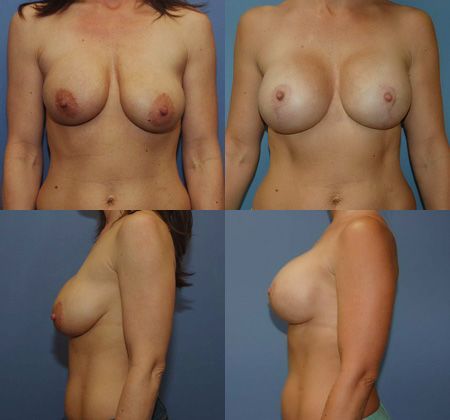 Breast Lift: Case 32