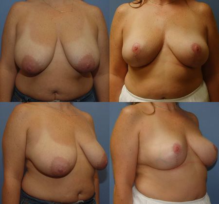 Breast Lift: Case 33