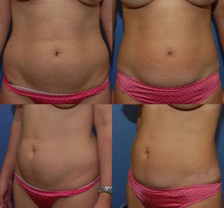 Liposuction: Case 4