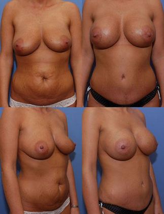 Tummy Tuck: Case 4