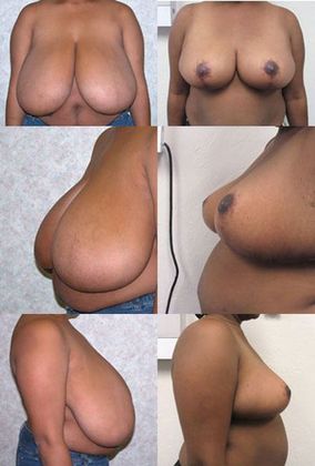 Breast Reduction: Case 4