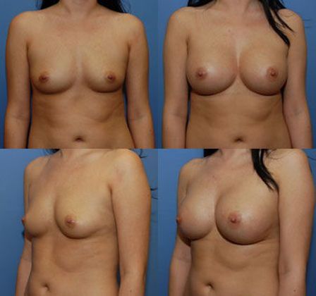 Case 041